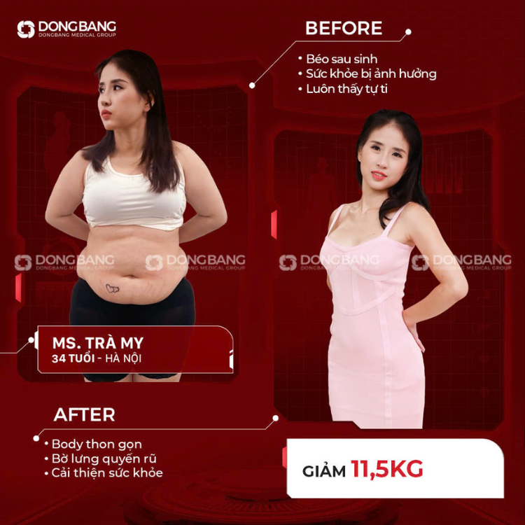 Hình ảnh chị Trà My trước sau khi giảm béo bằng liệu pháp cao