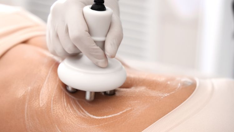 giảm béo liệu pháp cao có để lại sẹo không