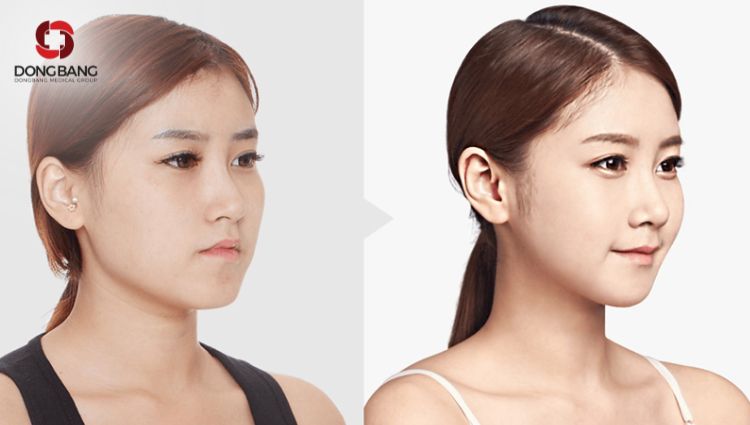 Chế độ ăn không lành mạnh gây mỡ mặt và mỡ toàn thân