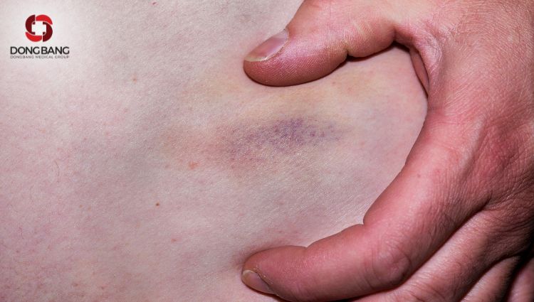 Lắc vòng gây bầm tím thường xuyên đối với người lắc sai kỹ thuật