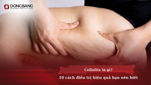 Cellulite là gì? 10 cách điều trị hiệu quả bạn nên biết
