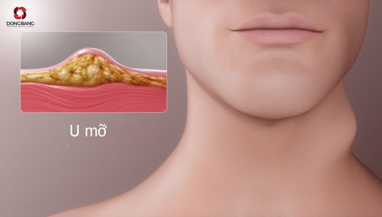 Tác động của u mỡ dưới da đến sức khỏe