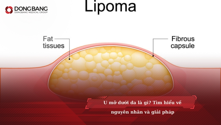 U mỡ dưới da là gì? Tìm hiểu về nguyên nhân và cách giảm mỡ hiệu quả