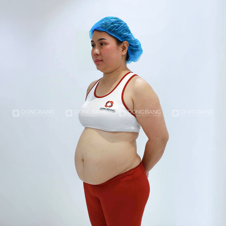 Hình ảnh chị My trước khi giảm cân tại Viện thẩm mỹ Dongbang